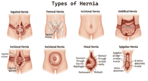 Hernias Pictures
